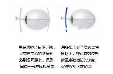 孩子眼睛度數(shù)持續(xù)加深？光學(xué)鏡片選擇與科學(xué)防控是關(guān)鍵